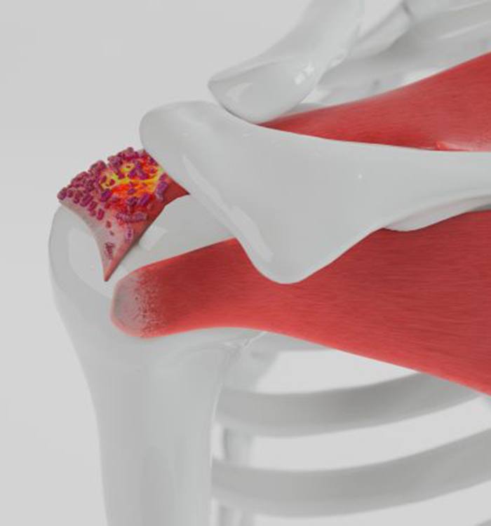 Illustration of calcific tendinitis in shoulder joint