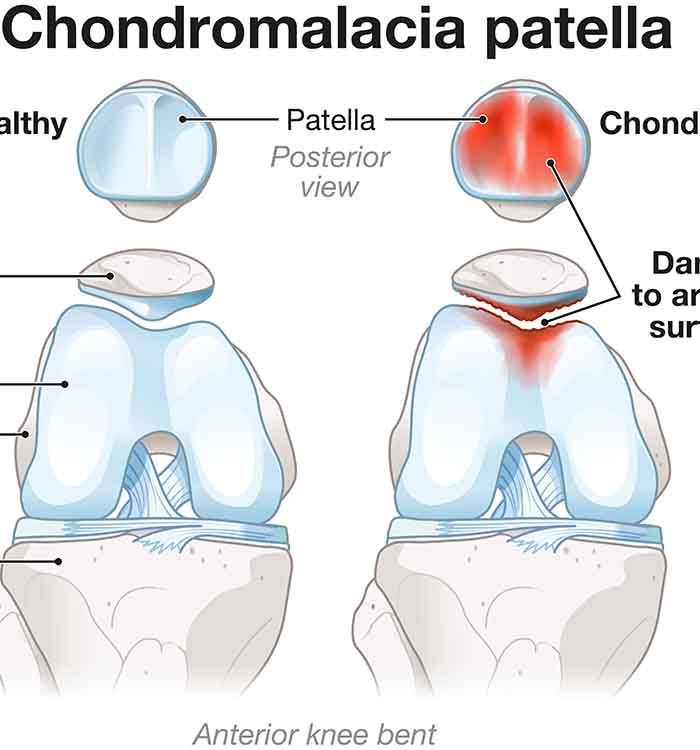 Diagram showing the difference between chondromalacia patellae and a healthy knee