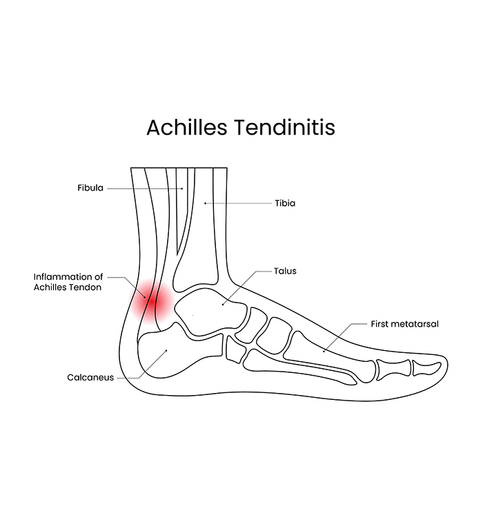 Simple diagram depicting Achilles tendonitis