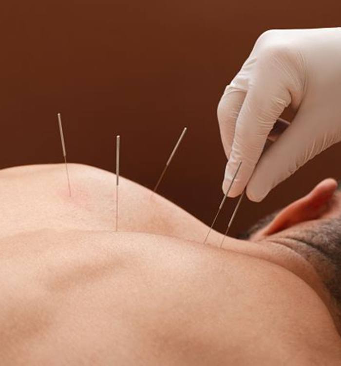 Man with several acupuncture needles in his back