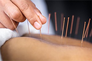 An example of medical acupuncture near Montford