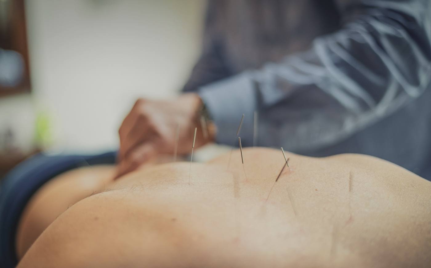 Physician performing medical acupuncture